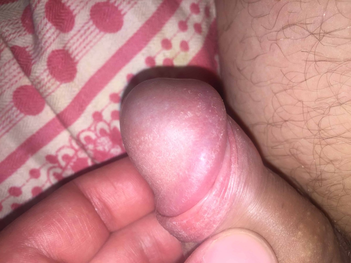 Пятнышки на головке члена