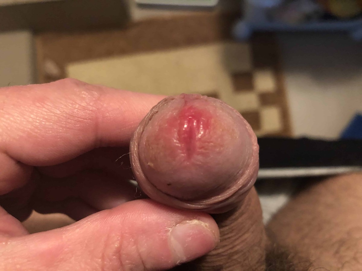 Прыщи после мастурбации на члене