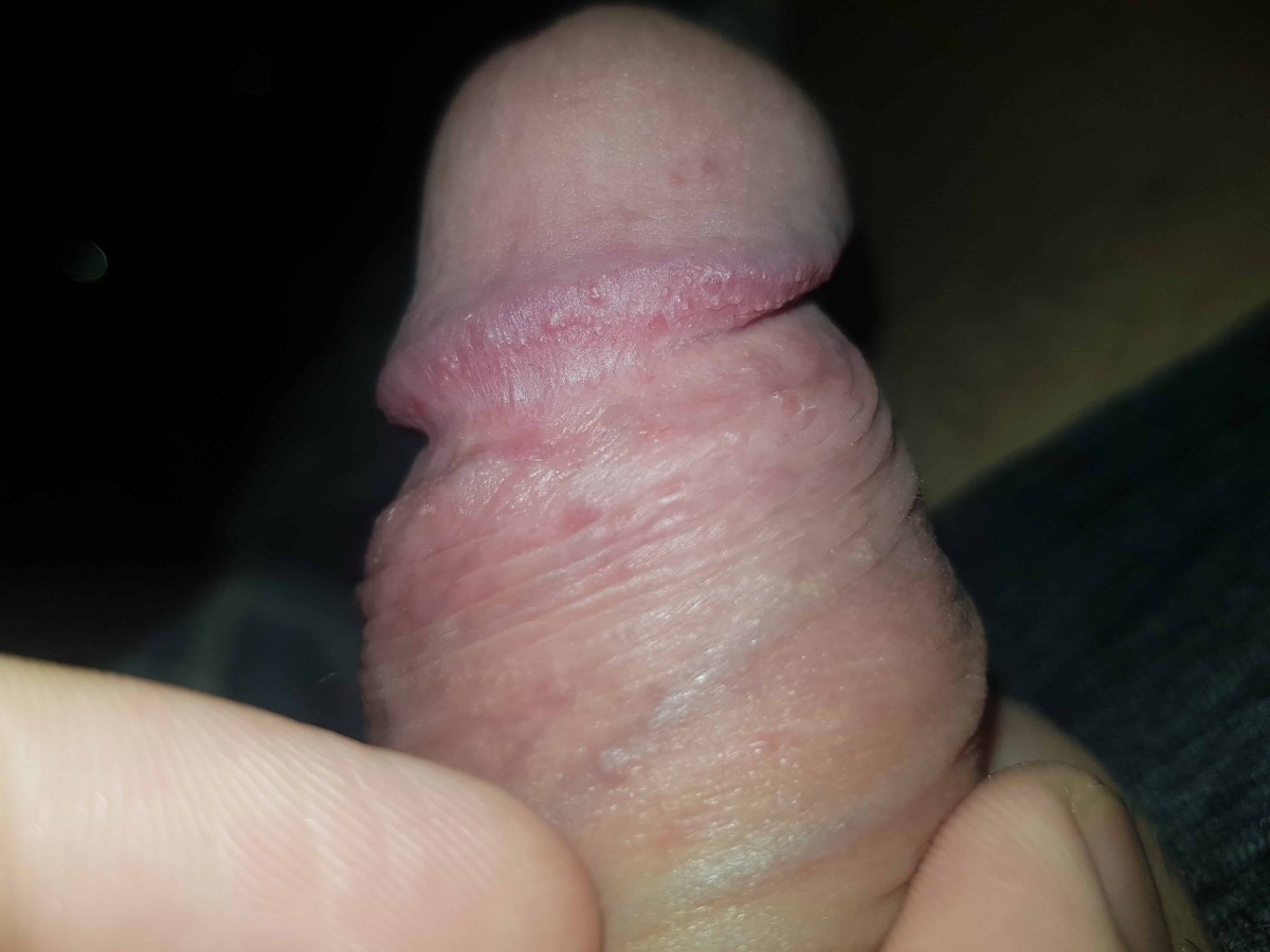 Белые пупырышки на головке члена