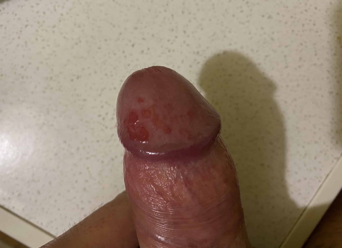 Красные пятнышки на залупе