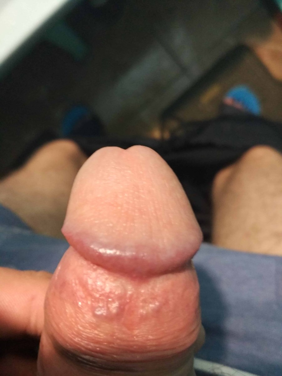 Белая кожица на пенисе