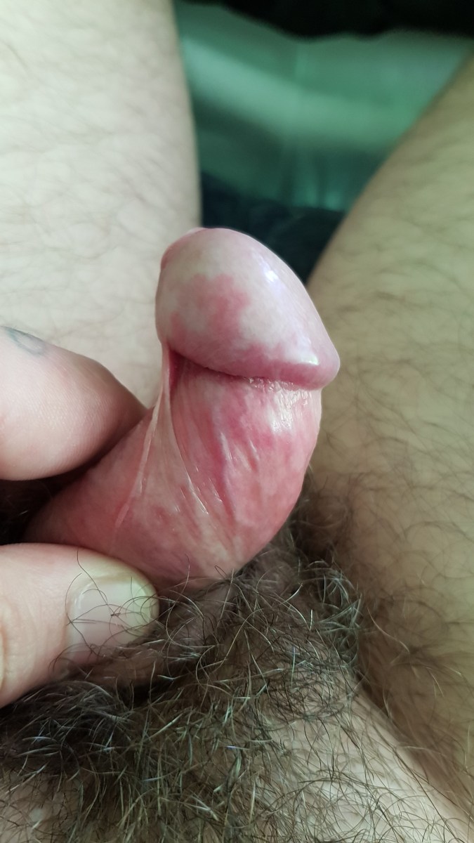 Красные пятнышки на залупе