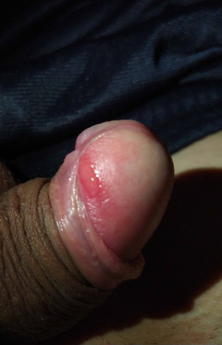 Белые пятна на головке члена