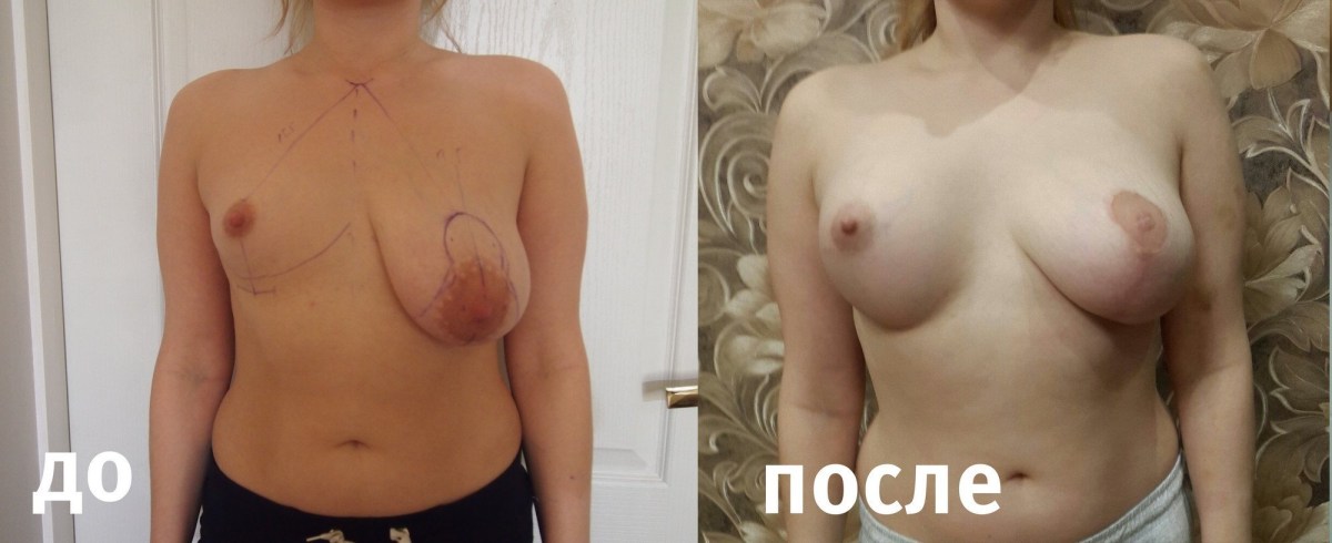 Голая грудь после родов